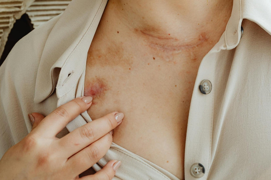 Close-up of dry, irritated skin — eczema treatment begins with understanding the skin barrier and the triggers that prevent it from healing