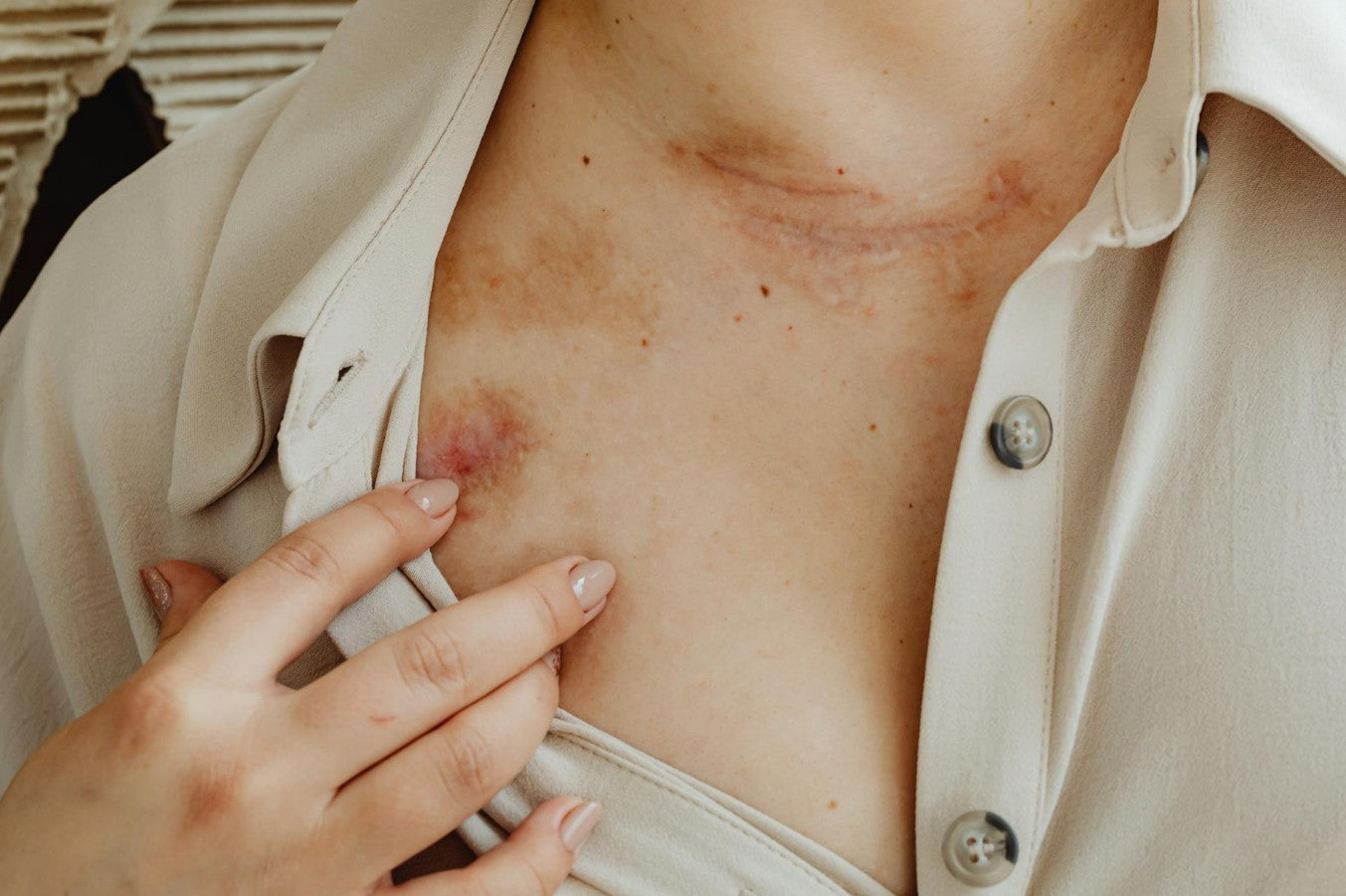 Close-up of dry, irritated skin — eczema treatment begins with understanding the skin barrier and the triggers that prevent it from healing