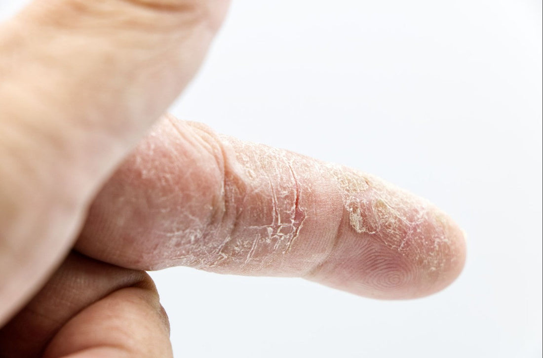 Close-up of dry, cracked skin on a finger illustrating hand eczema symptoms